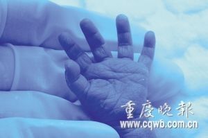 重慶最袖珍嬰兒僅重610克 腦袋僅有鵝蛋大